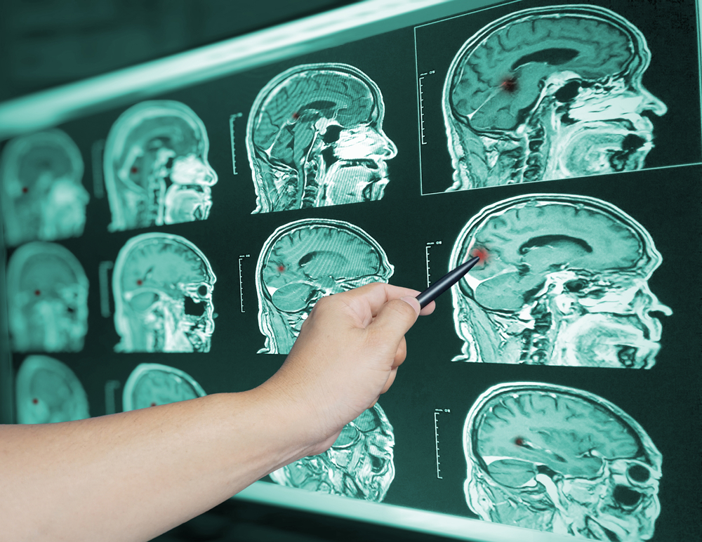 Avaliação Neuropsicológica em Casos de Traumatismo Craniano